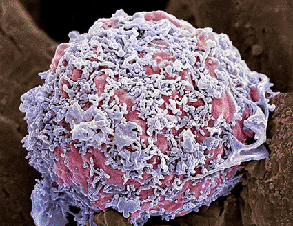 Image: Colored scanning electron micrograph (SEM) of a breast cancer cell (Photo courtesy of Steve Gschmeissner / SPL).